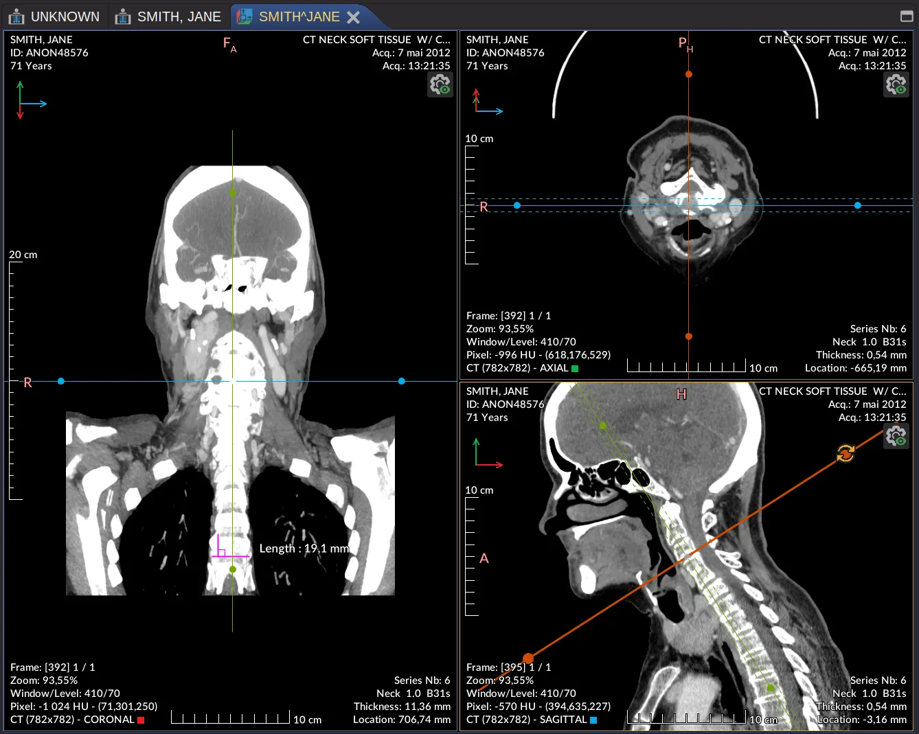 Weasis MPR viewer showing coronal, axial and sagittal CT views with synchronized crosshairs and a distance measurement.